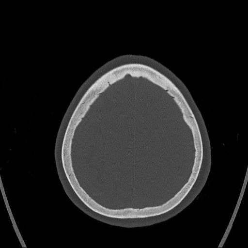 Cerebral venous infarction with hemorrhage (Radiopaedia 65343-74381 Axial bone window 159).jpg