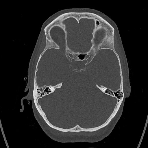 Cerebral venous infarction with hemorrhage (Radiopaedia 65343-74381 Axial bone window 40).jpg
