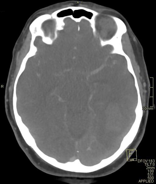 Cerebral venous sinus thrombosis (Radiopaedia 91329-108965 Axial venogram 35).jpg