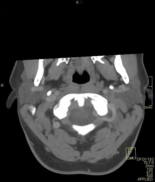 Cerebral venous sinus thrombosis (Radiopaedia 91329-108965 Axial venogram 7).jpg