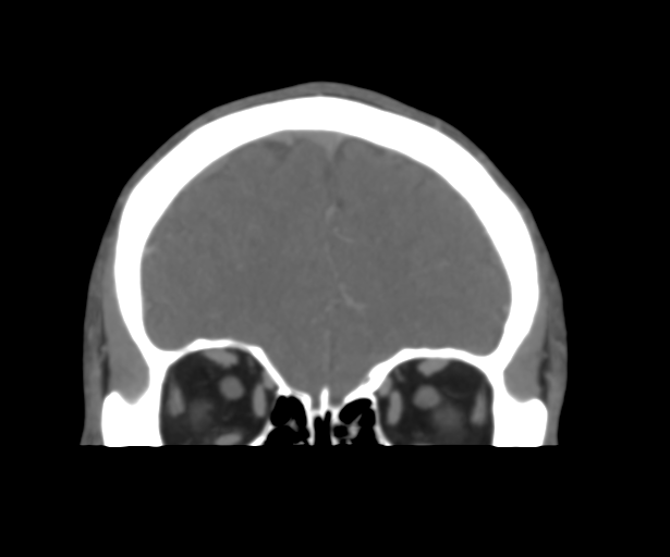 Cerebral venous thrombosis (Radiopaedia 38392-40467 Coronal CTA-Venogram 14).png