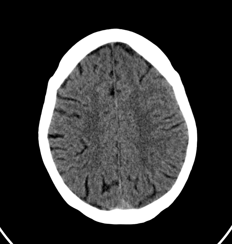 Cerebral venous thrombosis - CT only (Radiopaedia 41031-43778 Axial non-contrast 21).jpg