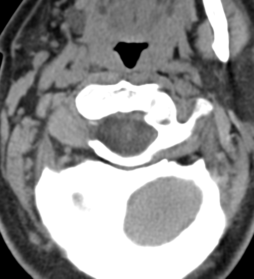 File:Cervical canal stenosis - OPLL and osteophytes (Radiopaedia 47329-51910 Axial non-contrast 15).png
