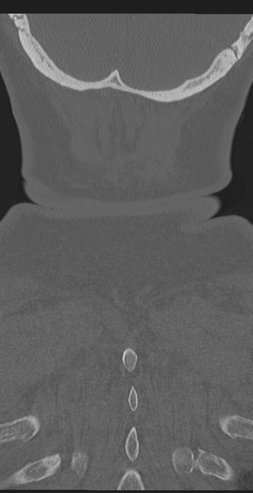 Cervical canal stenosis due to ossification of the posterior longitudinal ligament (Radiopaedia 47260-51823 Coronal bone window 67).png