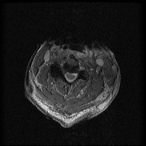 File:Cervical canal stenosis with cord compression (Radiopaedia 34114-35374 Axial Gradient Echo 55).png
