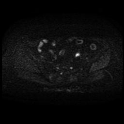 File:Cervical carcinoma (Radiopaedia 70924-81132 Axial DWI 20).jpg