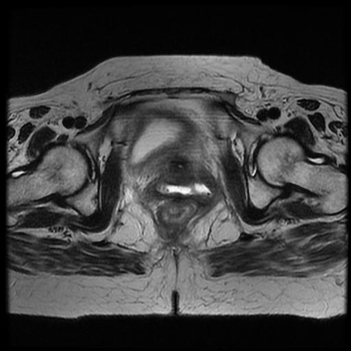 File:Cervical carcinoma (Radiopaedia 70924-81132 Axial T2 14).jpg