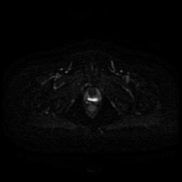 Cervical carcinoma (Radiopaedia 85405-101028 Axial DWI 3).jpg