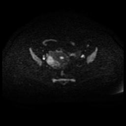File:Cervical carcinoma (Radiopaedia 88010-104555 Axial DWI 53).jpg