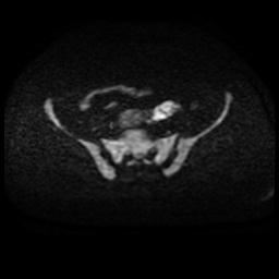 Cervical carcinoma (Radiopaedia 88010-104555 Axial DWI 59).jpg