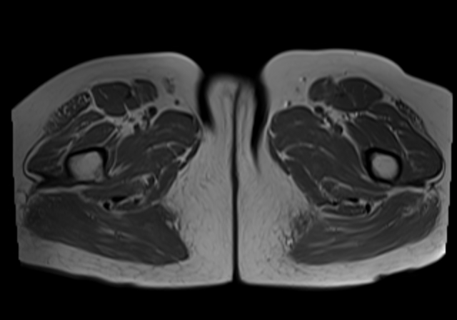 File:Cervical carcinoma (Radiopaedia 88312-104943 Axial T1 24).jpg