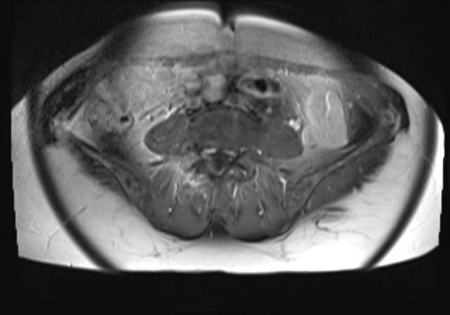 File:Cervical carcinoma (Radiopaedia 88312-104943 Axial T1 C+ fat sat 1).jpg