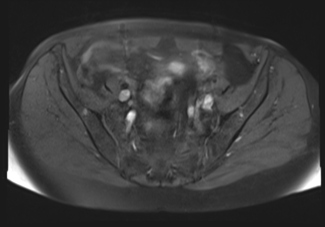 File:Cervical carcinoma (Radiopaedia 88312-104943 Axial T1 fat sat 8).jpg