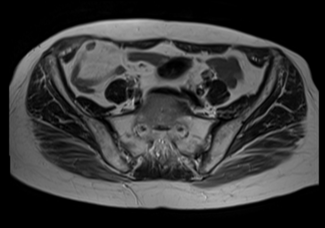 File:Cervical carcinoma (Radiopaedia 88312-104943 Sagittal T1 6).jpg