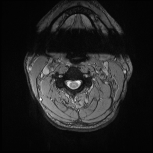 File:Cervical disc extrusion (Radiopaedia 53950-60077 Axial T2 8).jpg