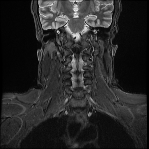 File:Cervical disc extrusion (Radiopaedia 59074-66364 Coronal STIR 5).jpg