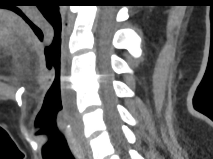 File:Cervical disc replacement (Radiopaedia 44025-47541 B 52).png