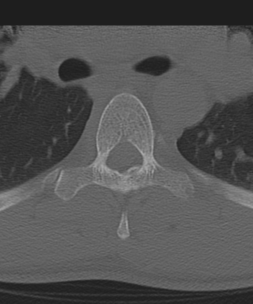 Cervical intercalary bone (Radiopaedia 35211-36748 Axial bone window 89).png