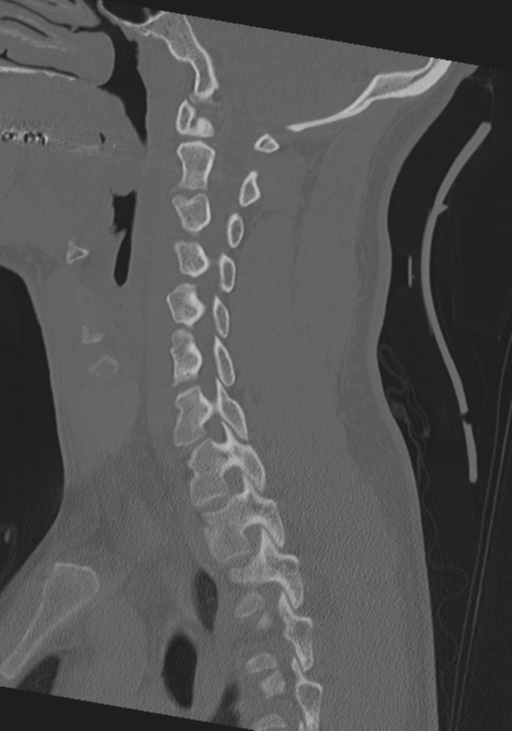 Cervical intercalary bone (Radiopaedia 35211-36748 Sagittal bone window 48).png