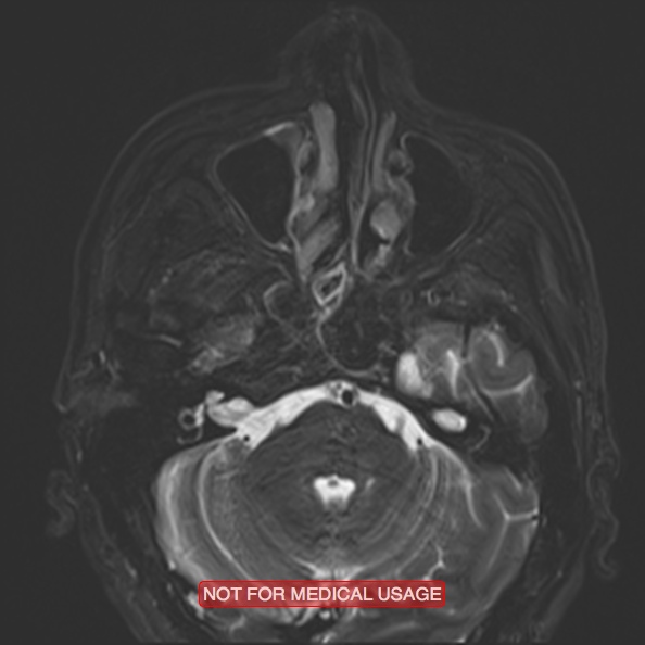 Cervical nerve schwannoma (Radiopaedia 27964-28221 C 13).jpg