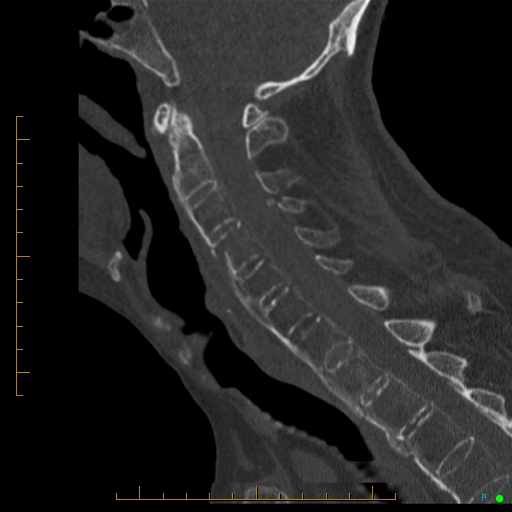 Cervical spine fracture - ankylosing spondylitis (Radiopaedia 76835-88706 Sagittal bone window 58).jpg
