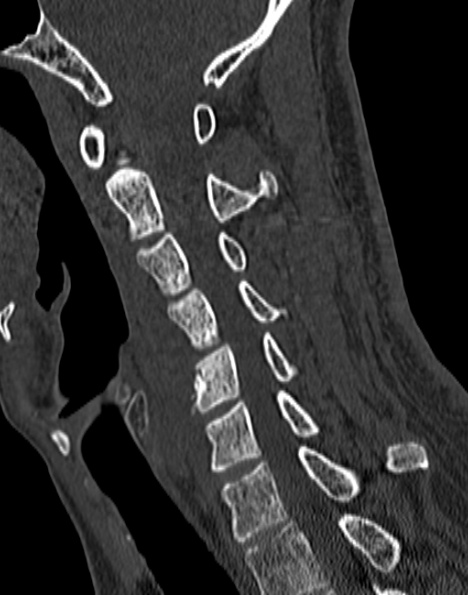 Cervical spondylodiscitis (Radiopaedia 28057-29489 Sagittal bone window 30).jpg