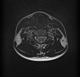 File:Cervical spondylodiscitis and calvarial hemangioma (Radiopaedia 64317-73104 Axial T2 14).jpg