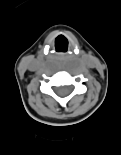 Cervical tuberculous spondylitis (Radiopaedia 39149-41365 Axial non-contrast 26).png