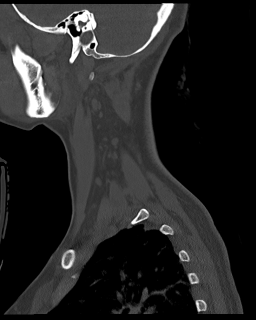 Cervical tuberculous spondylitis (Radiopaedia 39149-41365 Sagittal bone window 60).png
