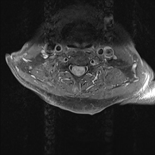 File:Cervical tumor-like myelopathy due to Type V dAVF (Radiopaedia 82461-96604 Axial T1 C+ fat sat 20).jpg