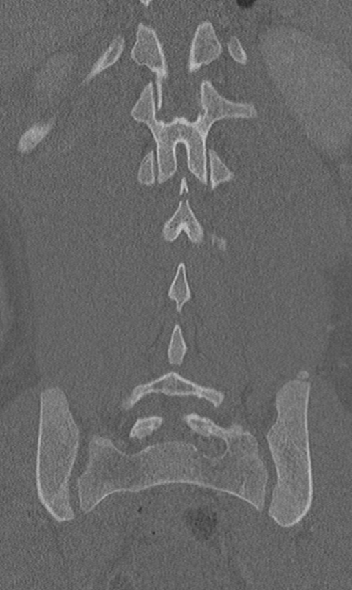Chance fracture (Radiopaedia 40360-42912 Coronal bone window 51).png