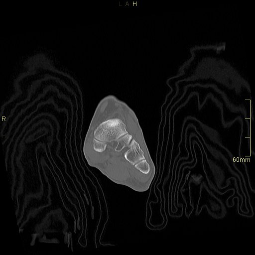 Chaput tubercle fracture (Radiopaedia 80319-93956 Coronal non-contrast 20).jpg