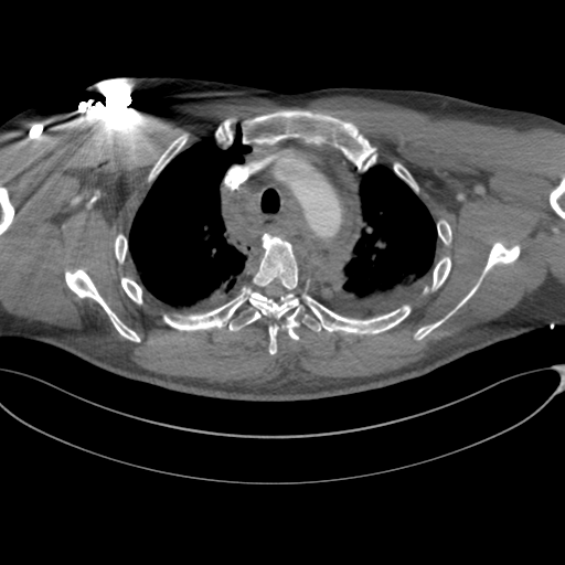 File:Chest multitrauma - aortic injury (Radiopaedia 34708-36147 A 77).png
