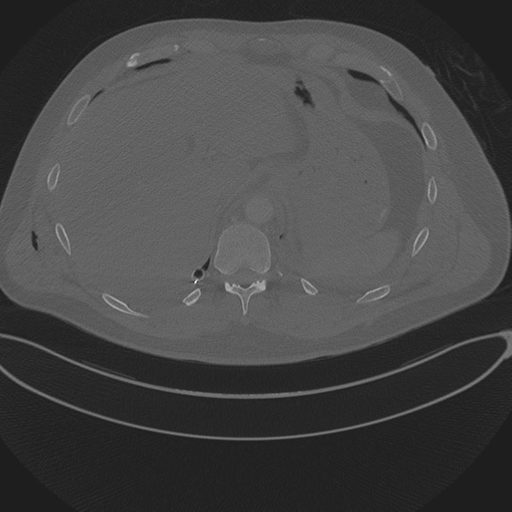 File:Chest multitrauma - aortic injury (Radiopaedia 34708-36147 Axial bone window 264).png