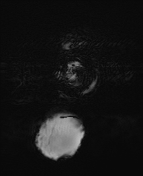 Chiari III malformation with occipital encephalocele (Radiopaedia 79446-92559 Axial SWI 8).jpg