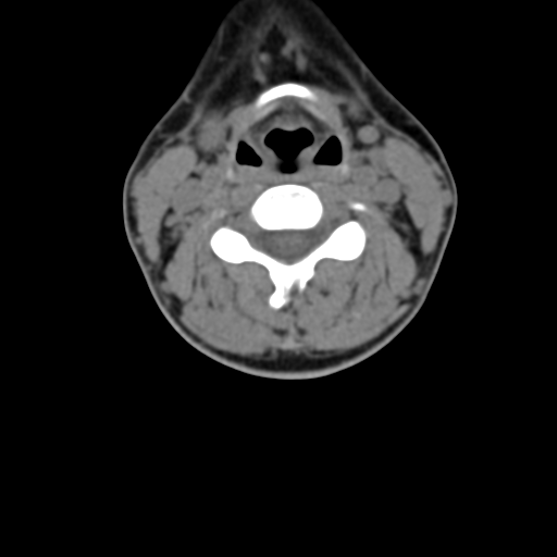 File:Chiari I malformation and obstructive hydrocephalus (Radiopaedia 41185-43981 D 54).png