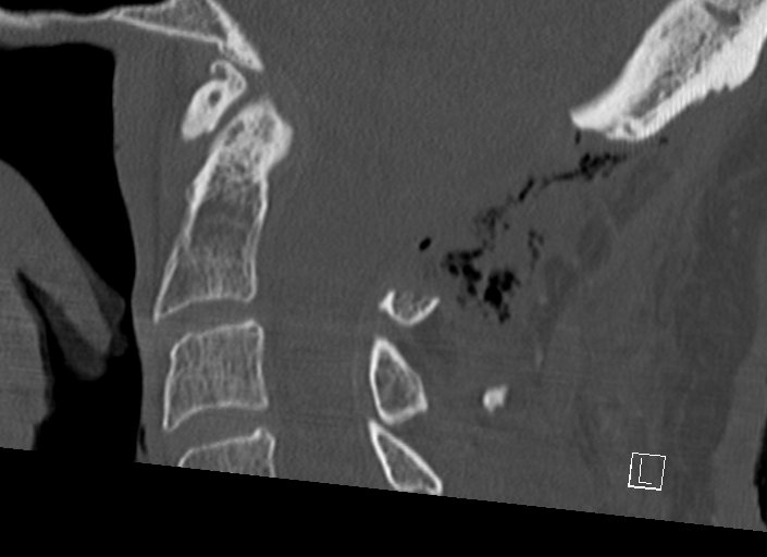 Chiari I malformation with a symptomatic syrinx of the posterolateral medulla oblongata (Radiopaedia 42573-45707 A 29).jpg