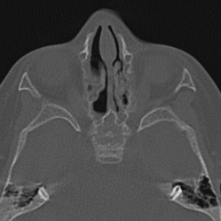 Choanal atresia (Radiopaedia 88525-105975 Axial bone window 58).jpg