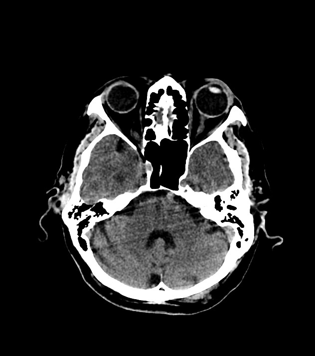 Cholangiocarcinoma with cerebral metastases (Radiopaedia 83519-98628 Axial non-contrast 22).jpg