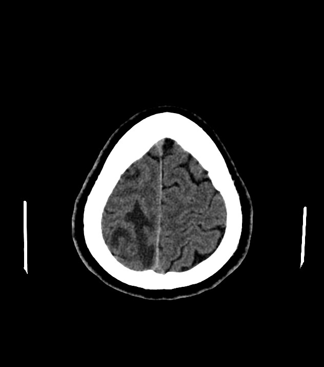 Cholangiocarcinoma with cerebral metastases (Radiopaedia 83519-98628 Axial non-contrast 56).jpg