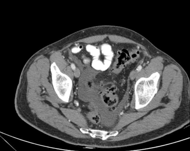 Cholecystitis - perforated gallbladder (Radiopaedia 57038-63916 A 72).jpg