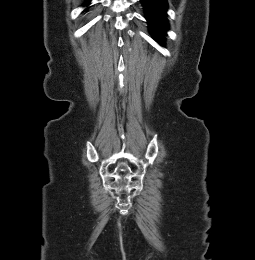 File:Cholecystoduodenal fistula due to calculous cholecystitis with gallstone migration (Radiopaedia 86875-103077 B 43).jpg