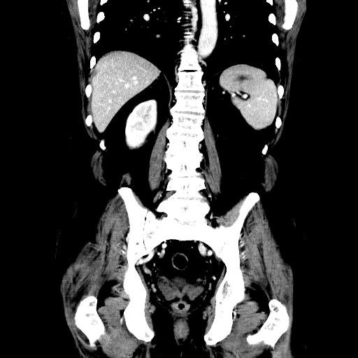 Choledocholiathiasis with normal caliber common bile duct (Radiopaedia 75368-86632 Coronal liver window 88).jpg