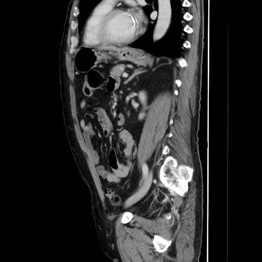 Choledocholiathiasis with normal caliber common bile duct (Radiopaedia 75368-86632 D 102).jpg