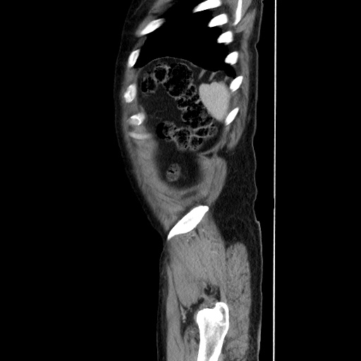 Choledocholiathiasis with normal caliber common bile duct (Radiopaedia 75368-86632 D 140).jpg