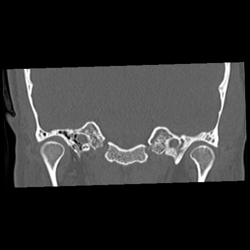 Cholesteatoma (Radiopaedia 84960-100474 Coronal bone window 25).jpg