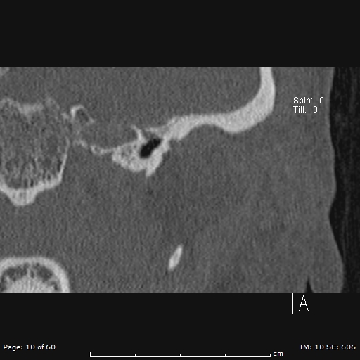 Cholesteatoma - external auditory canal (Radiopaedia 88452-105096 Coronal bone window 10).jpg