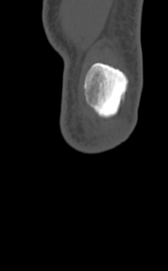 Chondrocalcinosis (Radiopaedia 82862-97173 Coronal bone window 4).jpg