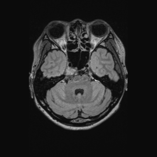 Chondrosarcoma (Radiopaedia 41937-44939 Axial FLAIR 42).png