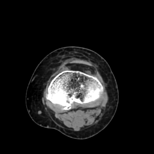 File:Chondrosarcoma - femur (Radiopaedia 64187-72954 Axial non-contrast 61).jpg